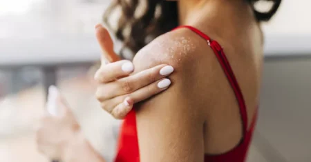 Pele descascando do sol: Um guia completo para entender e cuidar da sua pele!